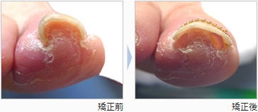 Ingrown nails correct