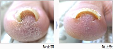 Ingrown nails correct