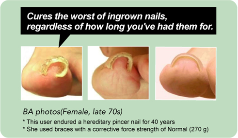 pincer nail remedy